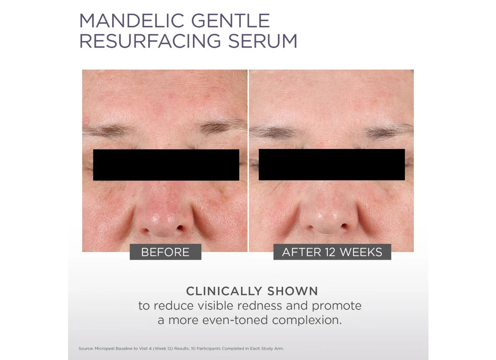 Glytone- Mandelic Gentle Resurfacing Serum